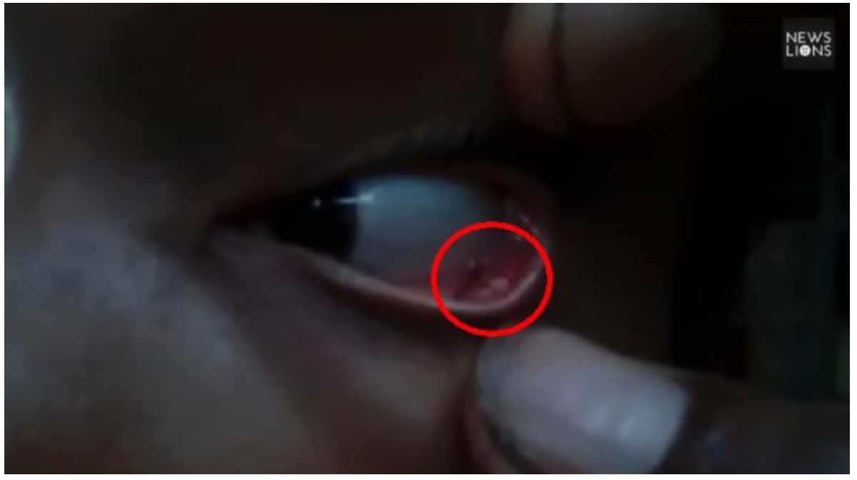 nangtime.com - Gatal Di Bahagian Mata, Tak Sangka Berpuluh Semut Ditemui Bawah Kelopak Mata Budak Perempuan