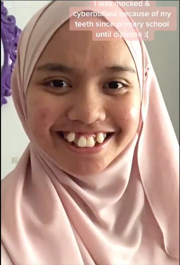 nangtime.com -  Sering Kena Buli Sebab Gigi Buruk Tak Teratur, Gadis Kongsi Perubahan Buat Ramai Terpegun