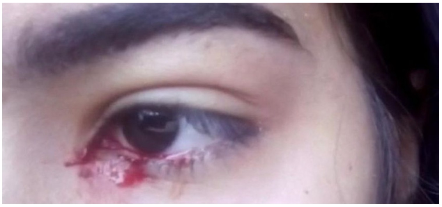 nangtime.com - Doktor Bingung, Gadis Ini Mengeluarkan Air Mata Darah Di Kedua Belah Mata
