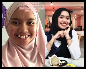 nangtime.com - Sering Kena Buli Sebab Gigi Buruk Tak Teratur, Gadis Kongsi Perubahan Buat Ramai Terpegun