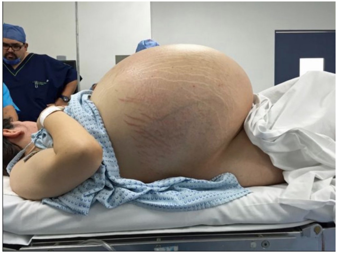 nangtime.com - Doktor Keluarkan Cyst Gergasi 33kg Dari Perut Wanita