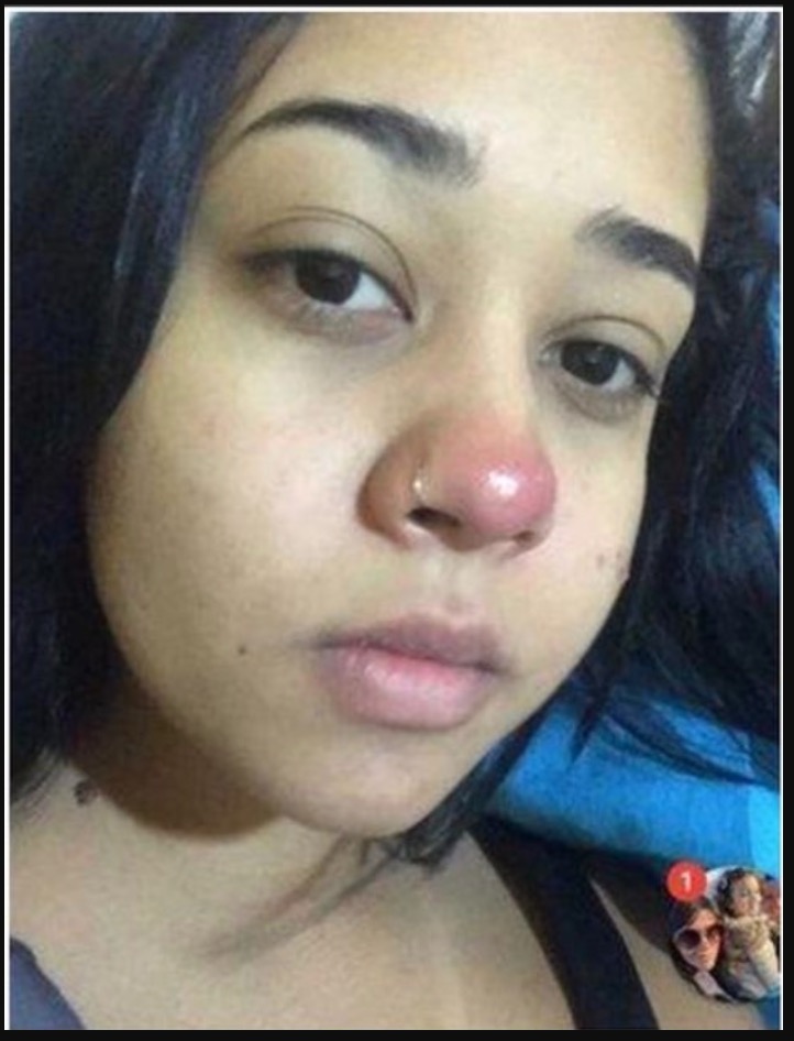 nangtime.com - Tindik Hidung Nak Ikut Trend Rakan Sebaya, Gadis Terpaksa Berkerusi Roda Seumur Hidup