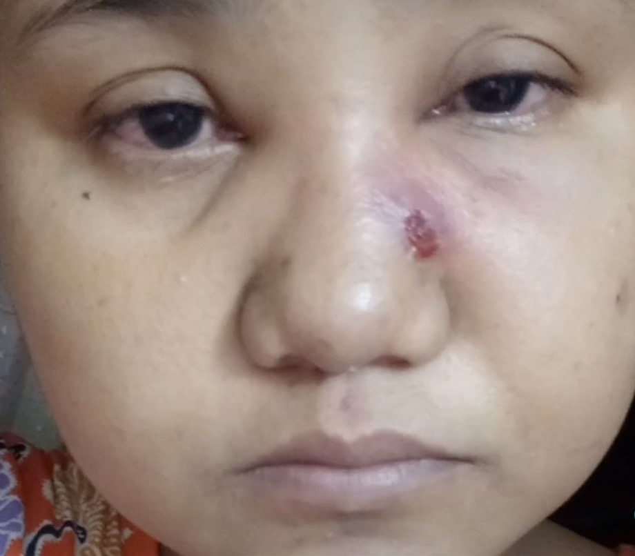 nangtime.com - Cecair Nanah Di Hidung Terus Meleleh Lepas Dipicit, Wanita Berdepan Risiko Nanah Naik Ke Kawasan Otak