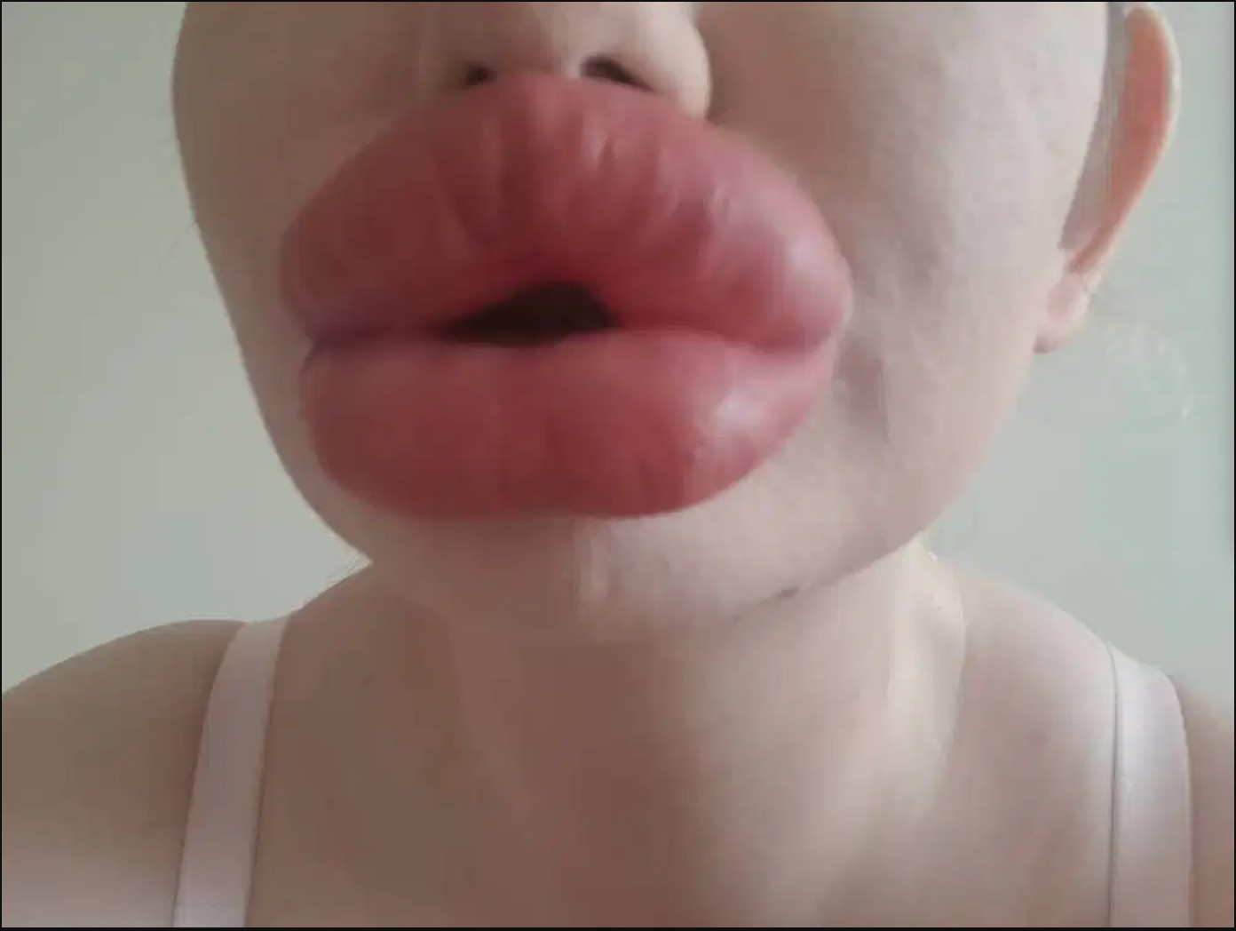 Wanita Memiliki Bibir Terbesar Di Dunia Masih Obses Meskipun Doktor Beri Amaran Agar Berhenti Membesarkan Bibirnya