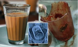 Lelaki Tertelan Gelas Ketika Minum Teh, Doktor Bingung Macam Mana Gelas Sebesar Itu Boleh Masuk Dalam Perut - nangtime.com